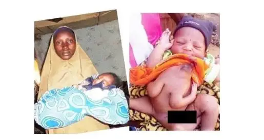 Woman Delivers Baby With 4 Legs and 3 Hands