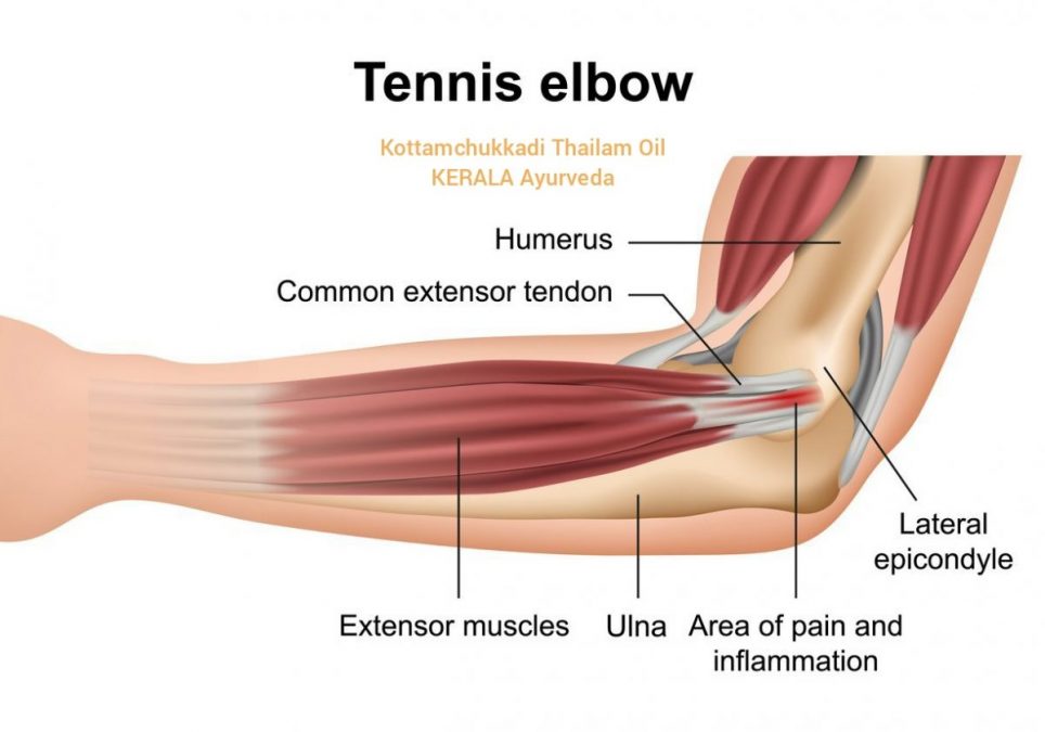 Tennis Elbow Causes, Symptoms & Treatment in Ayurveda