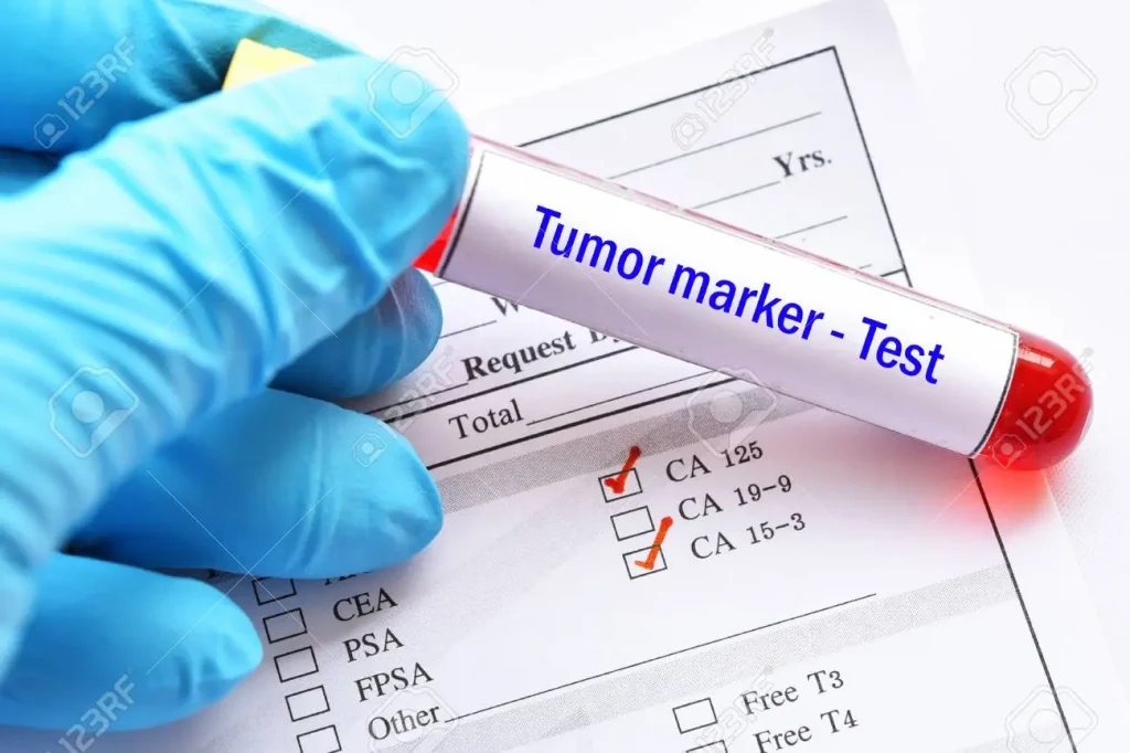 Tumor marker C 19-9 blood test for cancer