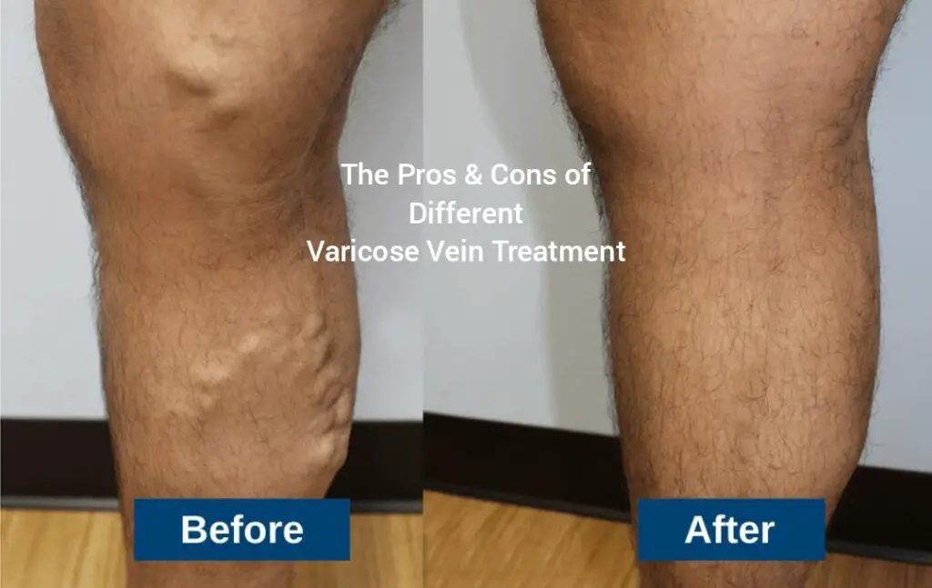 The Pros and Cons of Different Varicose Vein Treatment Options from a Cost Perspective